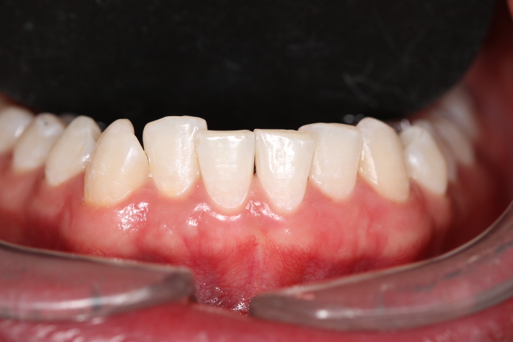 Encías sanas y dientes limpios tras la limpieza dental profesional