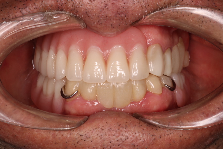 Resultado tras rehabilitación oral: función masticatoria y estética restauradas