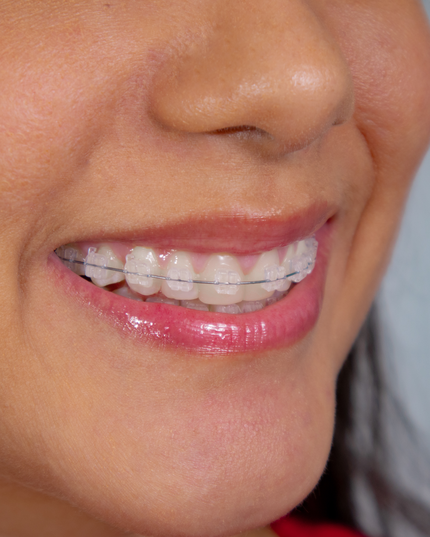 Paciente con brackets de zafiro transparentes